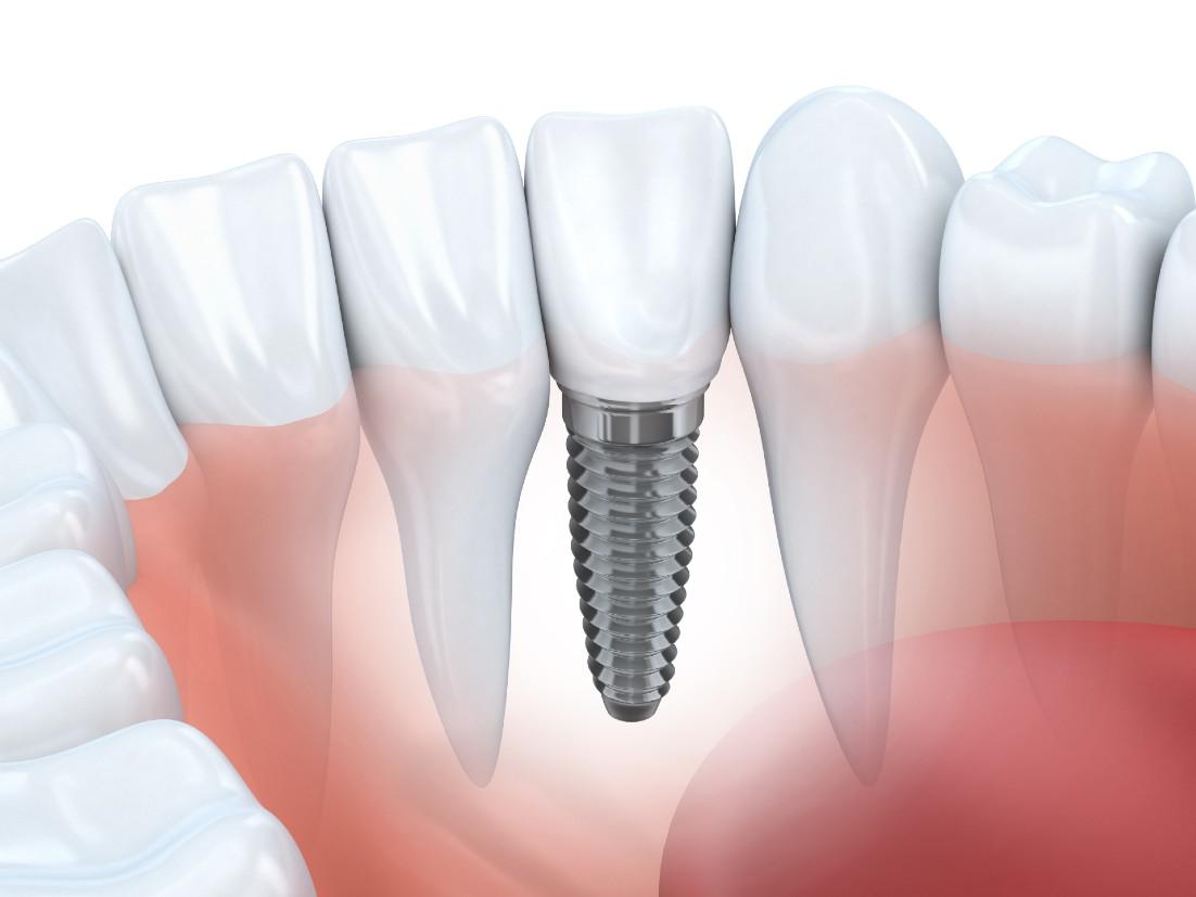 Dental Implants Rockville, MD